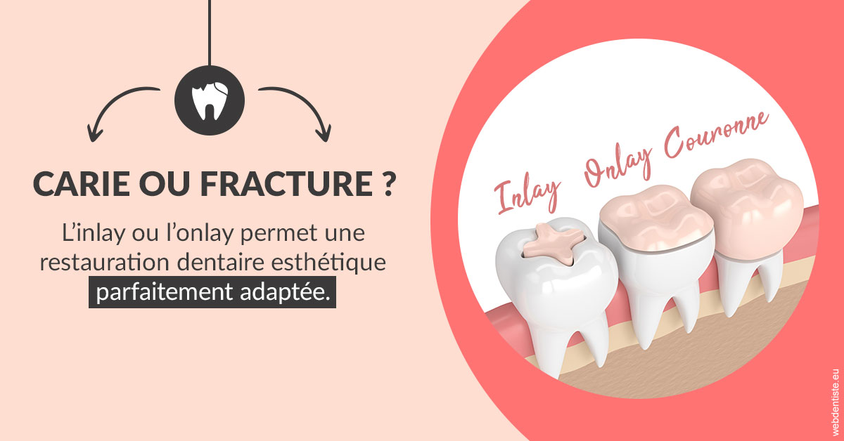 https://dr-marchou-maxime.chirurgiens-dentistes.fr/T2 2023 - Carie ou fracture 2