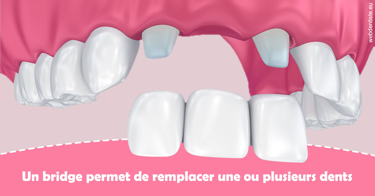 https://dr-marchou-maxime.chirurgiens-dentistes.fr/Bridge remplacer dents 2