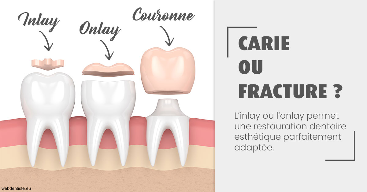 https://dr-marchou-maxime.chirurgiens-dentistes.fr/T2 2023 - Carie ou fracture 1