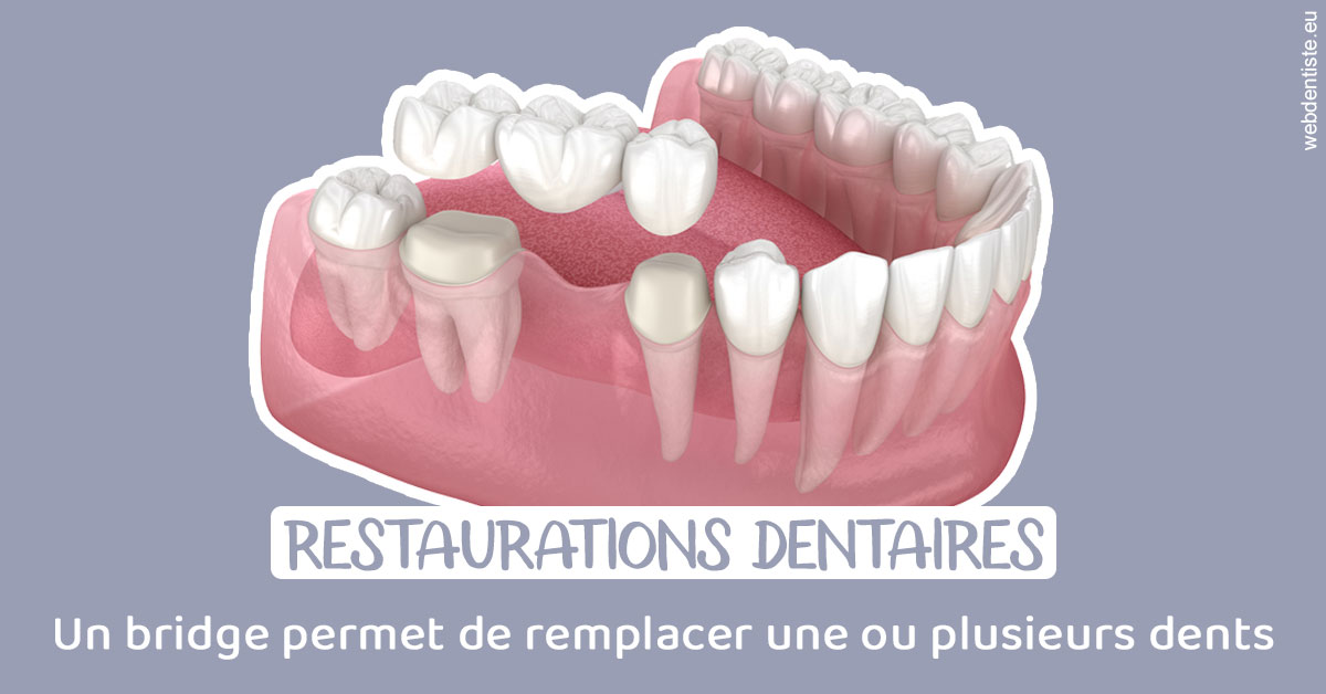 https://dr-marchou-maxime.chirurgiens-dentistes.fr/Bridge remplacer dents 1