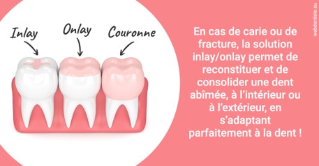 https://dr-marchou-maxime.chirurgiens-dentistes.fr/L'INLAY ou l'ONLAY 2