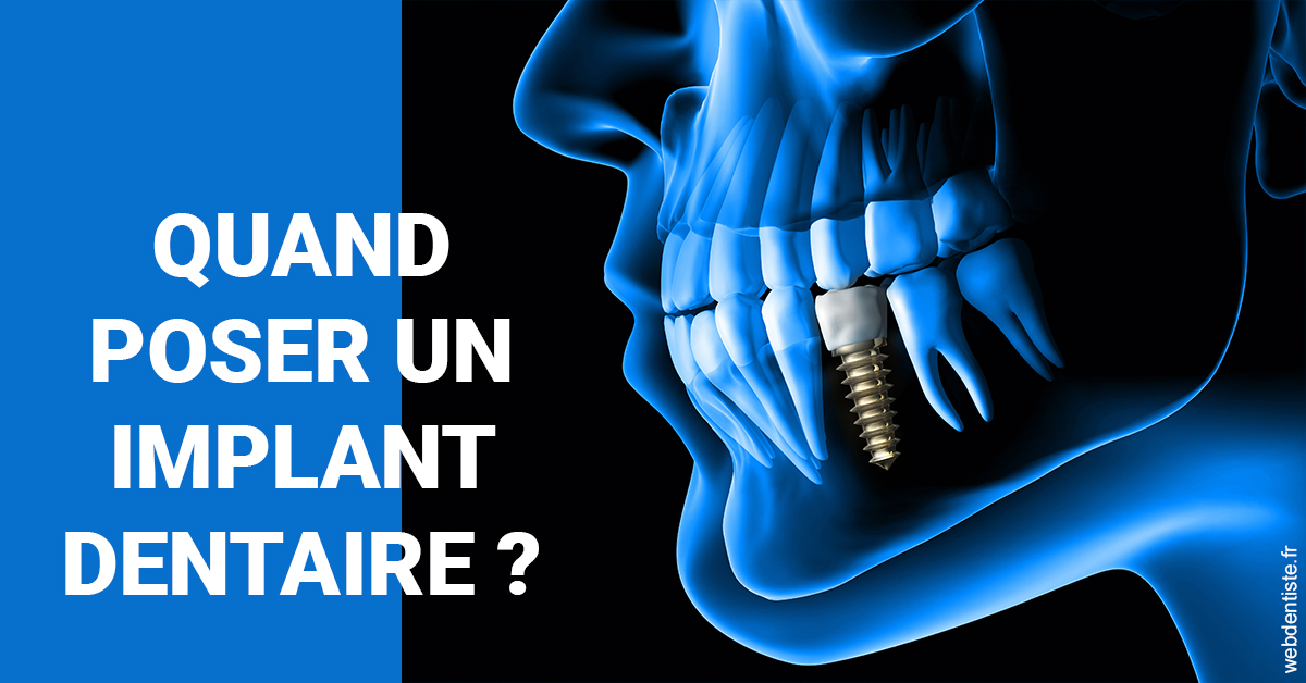 https://dr-marchou-maxime.chirurgiens-dentistes.fr/Les implants 1