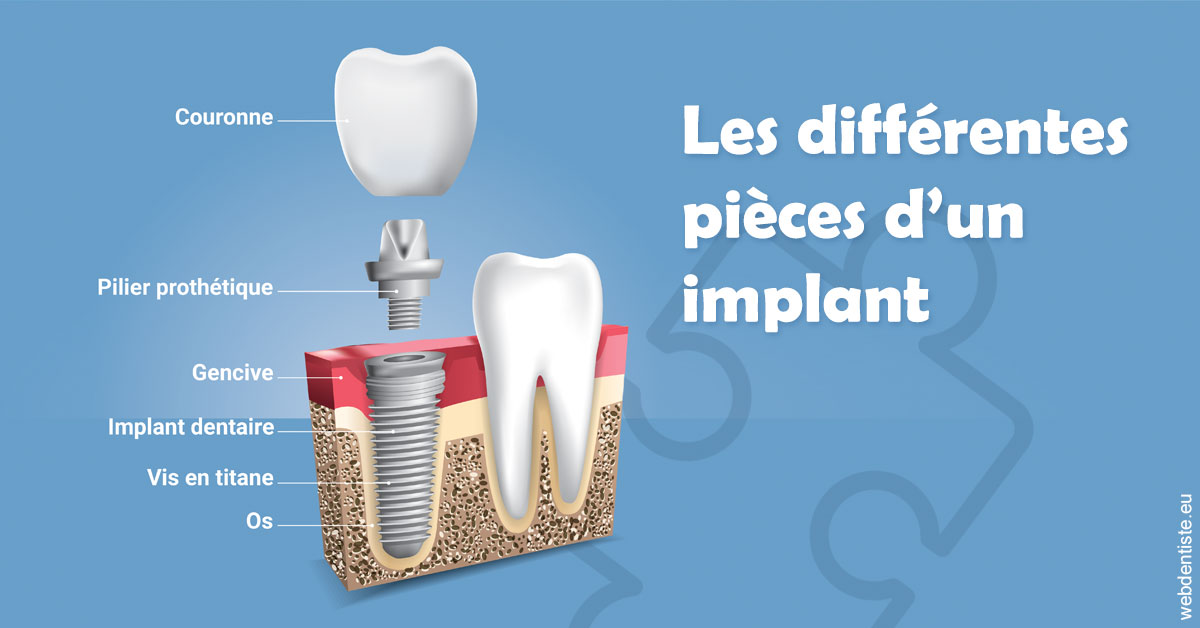 https://dr-marchou-maxime.chirurgiens-dentistes.fr/Les différentes pièces d’un implant 1