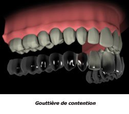 gouttiere-transparente-1