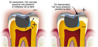 barotraumatisme-dentaire-1