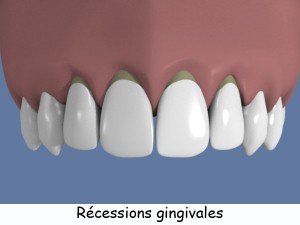 recession_gingivale-2